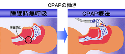 CPAP装置を使用した場合の気道の様子